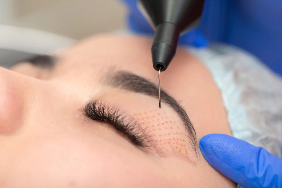 Plasma Fibroblast Skin Tightening Treatment