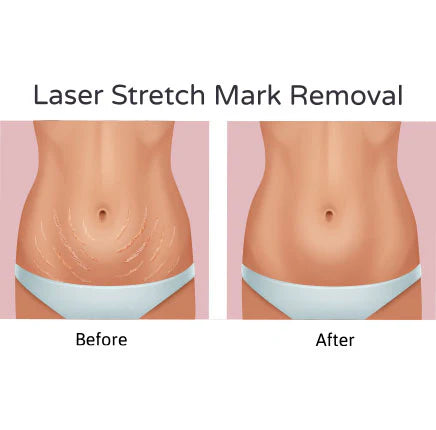 Stretch Mark Treatment (Tummy)