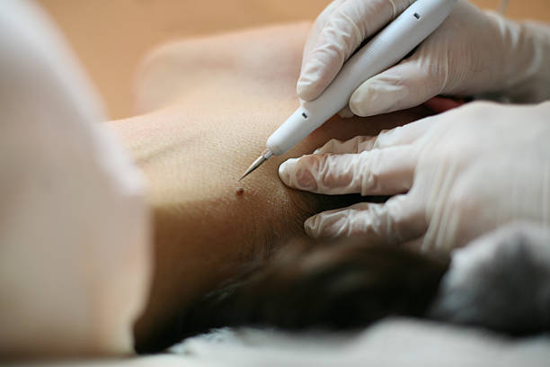 Skin Tag / Milia Removal