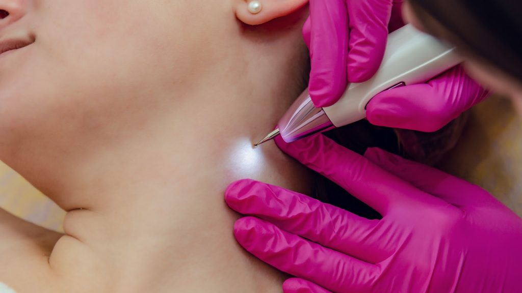 Skin Tag / Milia Removal